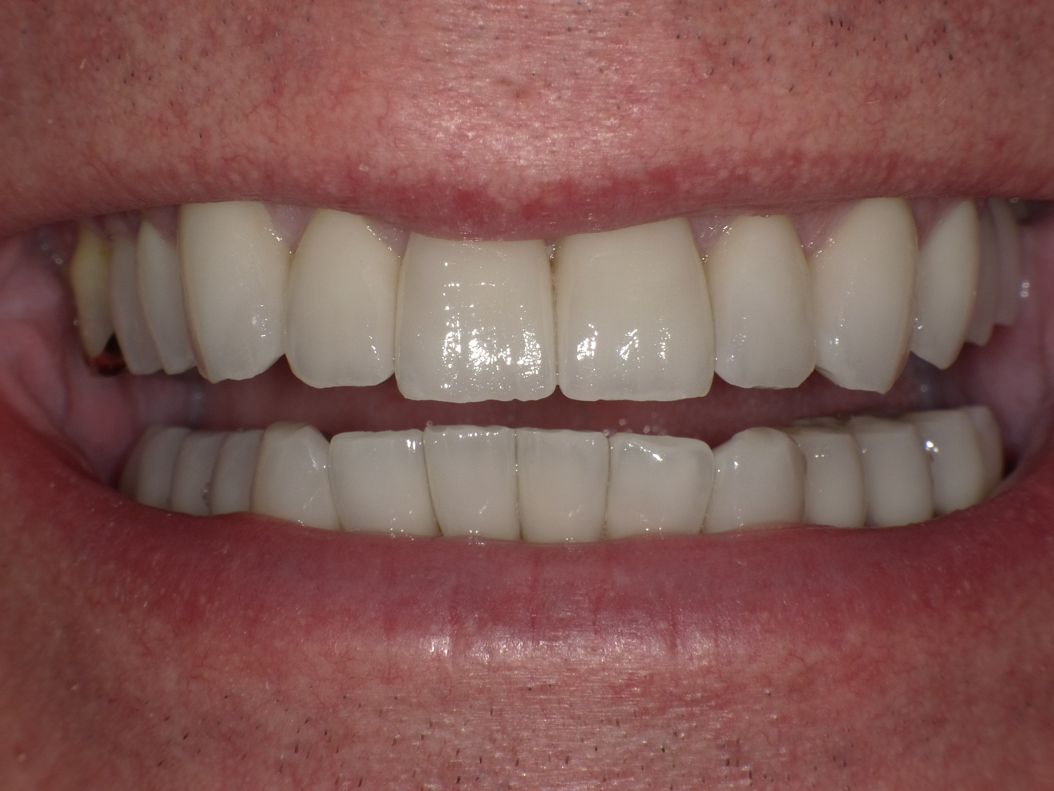 Ästhetische Optimierung mit vollkeramischen Veneers und Kronen in nur 2 Terminen